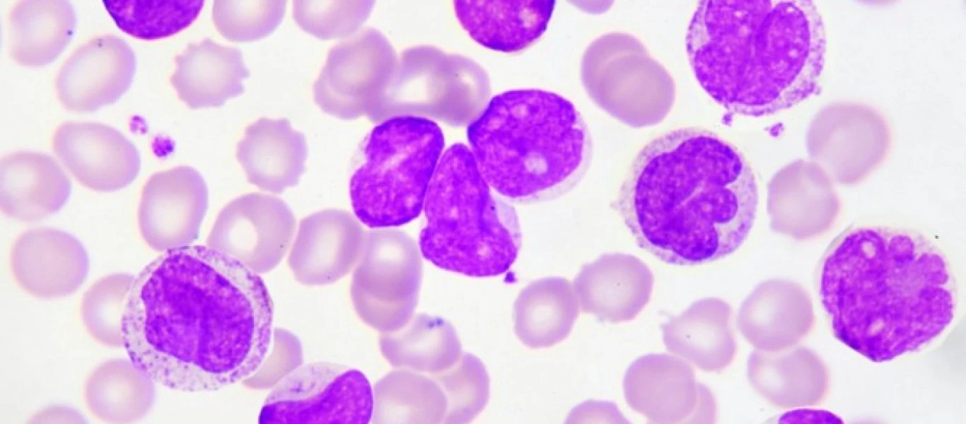 Λευχαιμία: Ποια είναι η θεραπεία για κάθε τύπο